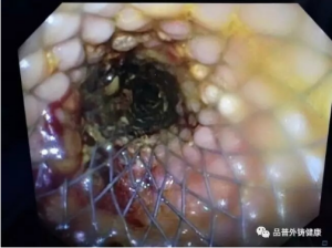 腸道支架植入后有糞水和氣體排出_副本.png