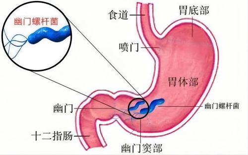 幽門螺桿菌_副本.png
