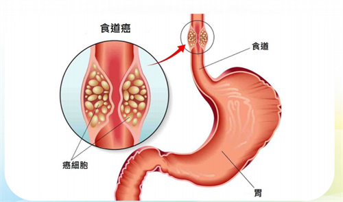食管癌.png