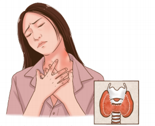 甲狀腺癌.png