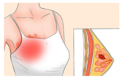 乳腺癌.png