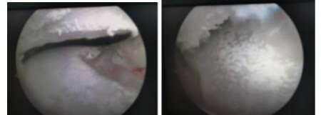 痛風(fēng)石1_副本.png