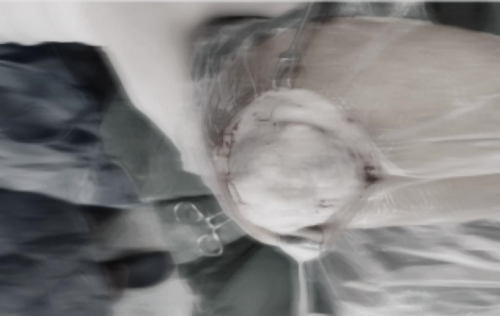 痛風(fēng)石_副本.png