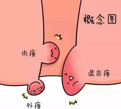 內痔_副本.png