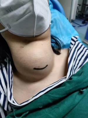甲狀腺腫物_副本.png